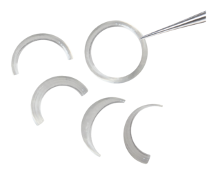 CAIRS laser-prepared allogenic ring segments